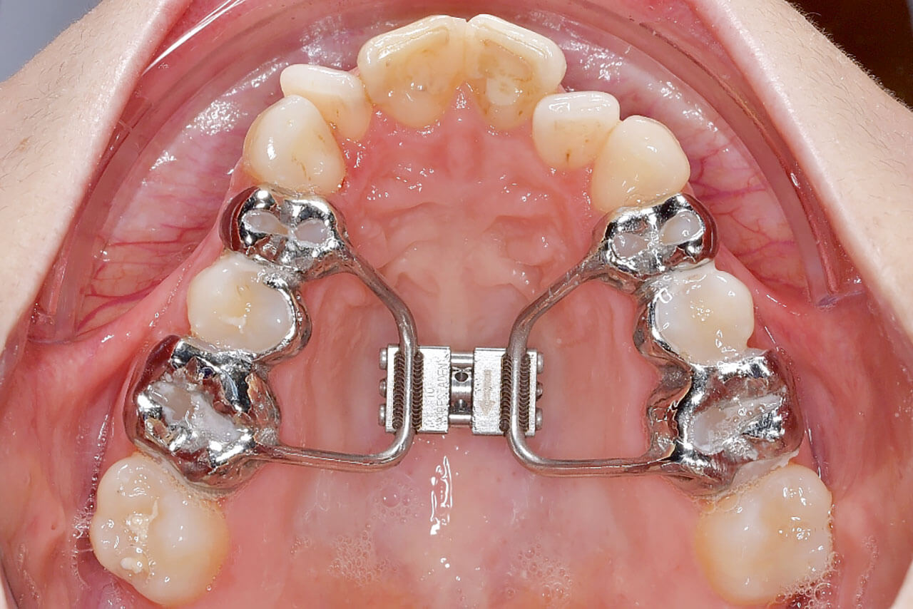 Abb. 2 Rigide Erweiterungsapparatur zur konservativen, nicht chirurgisch unterstützten transversalen Erweiterung der Maxilla.