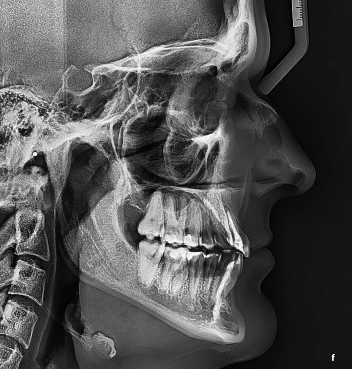 Abb. 4a bis g Klinischer und radiologischer Zustand nach erfolgreich überstellter Kreuzbisssituation im Front- und Seitenzahnbereich. Gerade beim Vergleich der Frontalansichten zu Behandlungsbeginn (s. Abb. 1a) mit Behandlungsabschluss (a) wird deutlich, dass weder eine kompensatorische Bukkalkippung der Seitenzähne im Oberkiefer noch eine kompensatorische Lingualkippung der Seitenzähne im Unterkiefer stattgefunden hat. Die Inklination der Seitenzähne wirkt daher nicht übermäßig kompensiert. Auch die bereits vor Beginn der kieferorthopädischen Behandlung existierenden Rezessionen in Regio 16 und 26 wurden aufgrund der Zahnbewegung nicht vergrößert (b und c). Die Aufbissaufnahmen (d und e) zeigen die zuverlässige Umsetzung der individuellen Planung.