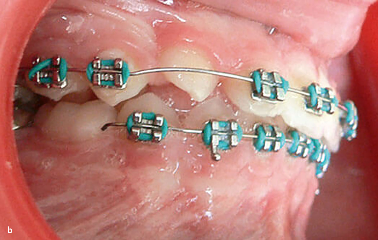 Abb. 9a bis h Nach Entfernung der kortikalen Verankerung wurde eine einjährige Behandlungspause eingelegt, um nach vollständigem Zahndurchbruch die Ausformung der Zahnbögen mit einer festsitzenden Apparatur vornehmen zu können.