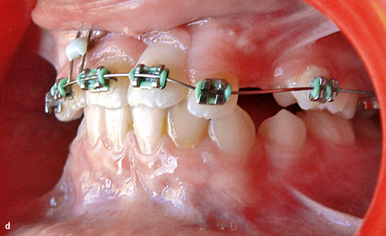 Abb. 9a bis h Nach Entfernung der kortikalen Verankerung wurde eine einjährige Behandlungspause eingelegt, um nach vollständigem Zahndurchbruch die Ausformung der Zahnbögen mit einer festsitzenden Apparatur vornehmen zu können.
