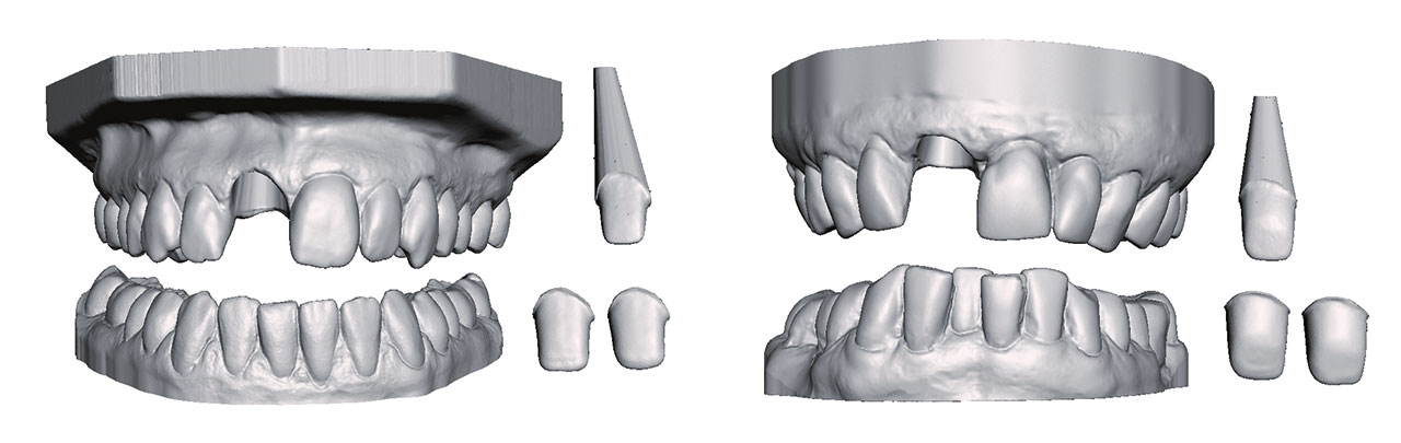 Abb. 2  STL-Files der Modelle (Ober- und Unterkiefer) mit Zahnstumpf und STL-Files der Gerüste (zwei Varianten: für Zirkonoxidgerüst oder Gerüst aus einer Metalllegierung), jeweils für eine junge (linkes Bild) und eine ältere (rechtes Bild) Bezahnung.