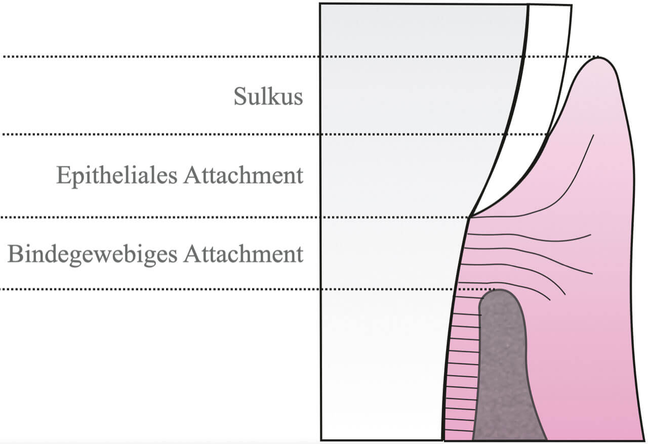 Abb. 5 Schematische Darstellung der biologischen Breite gemäß Gargiulo et al.10. Die biologische Breite setzt sich aus dem epithelialen (0,97 mm) sowie dem binde­gewebigen (1,07 mm) Attachment zusammen. Sie beträgt durchschnittlich 2,04 mm. 