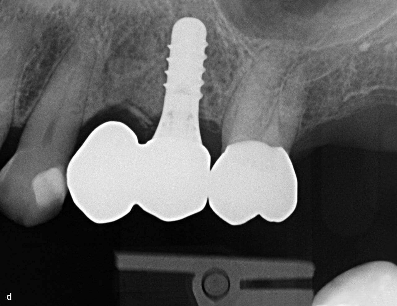 Abb. 3a bis d Klinische (a) und radiologische (b) Situation einer implantatgetragenen Extensionsbrücke in der Unterkieferfront bei einer reduzierten Bezahnung im Seitenzahnbereich zur Vermeidung einer abnehmbaren Versorgung sowie klinische (c) und radio­logische (d) Situation einer implantatgetragenen Extensionsbrücke im Seitenzahnbereich als Alternative zu einer zahngetragenen viergliederigen Brückenversorgung.