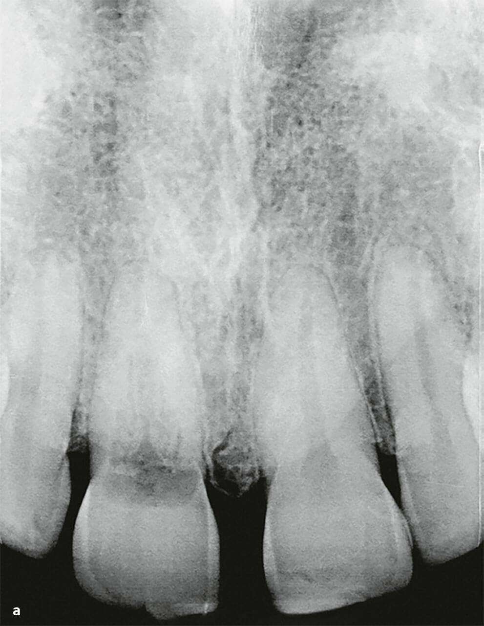 Abb. 2a Präoperatives Röntgenbild von Zahn 11.