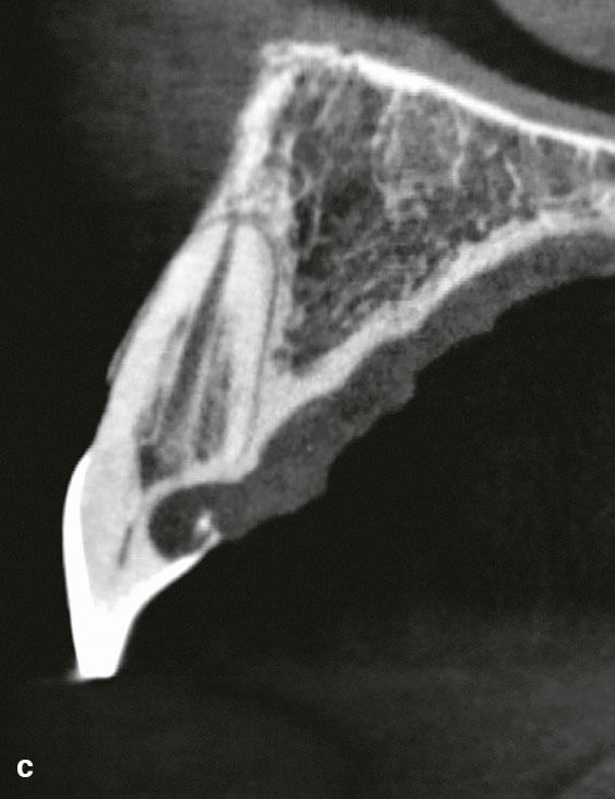 Abb. 2c Die Aufnahme mit digitaler Volumentomografie (DVT) von Zahn 11 (sagittale Schicht) zeigt eine invasive zervikale Resorption (IZR) der Klasse 4 nach Heithersay.