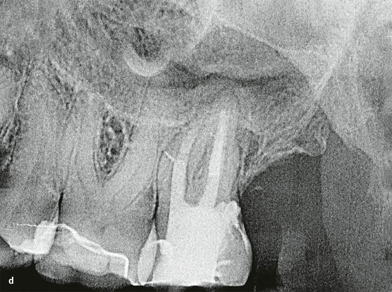 Abb 3d Postoperatives Röntgenbild von Zahn 27.