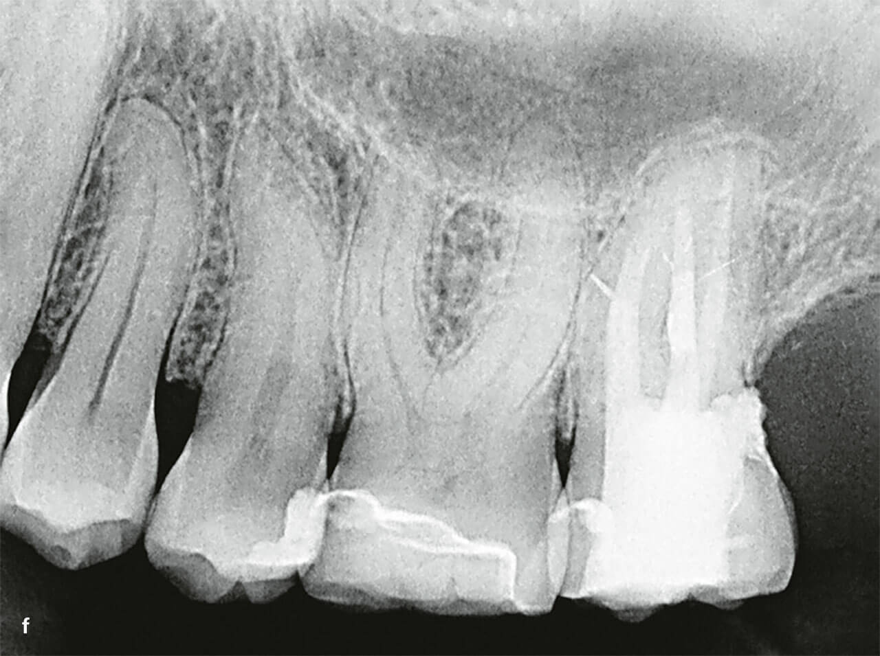 Abb 3f Periapikale Röntgenaufnahme von Zahn 27 bei der Nachuntersuchung nach 4,5 Jahren.
