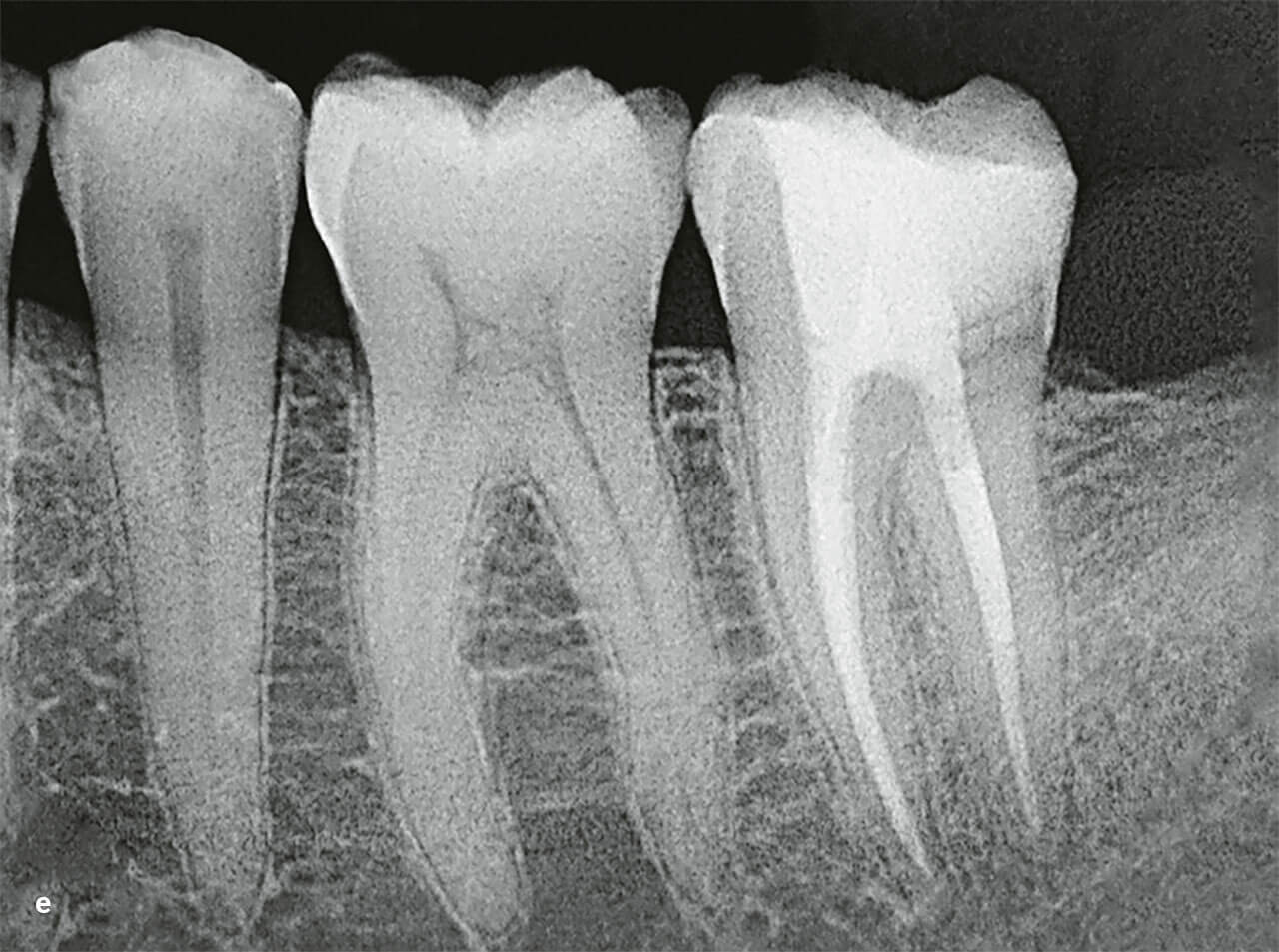 Abb 4e Röntgenkontrollaufnahme von Zahn 37 nach 9 Monaten.