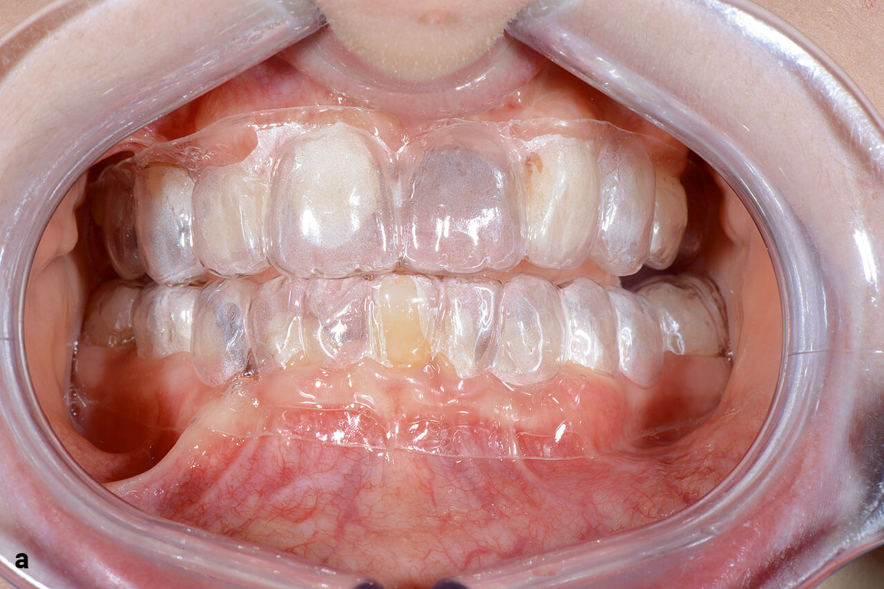 Abb. 3a Herstellung des Langzeitprovisoriums: Tiefziehfolie intraoral, hergestellt auf Basis des Wax-ups vor Mock-up.