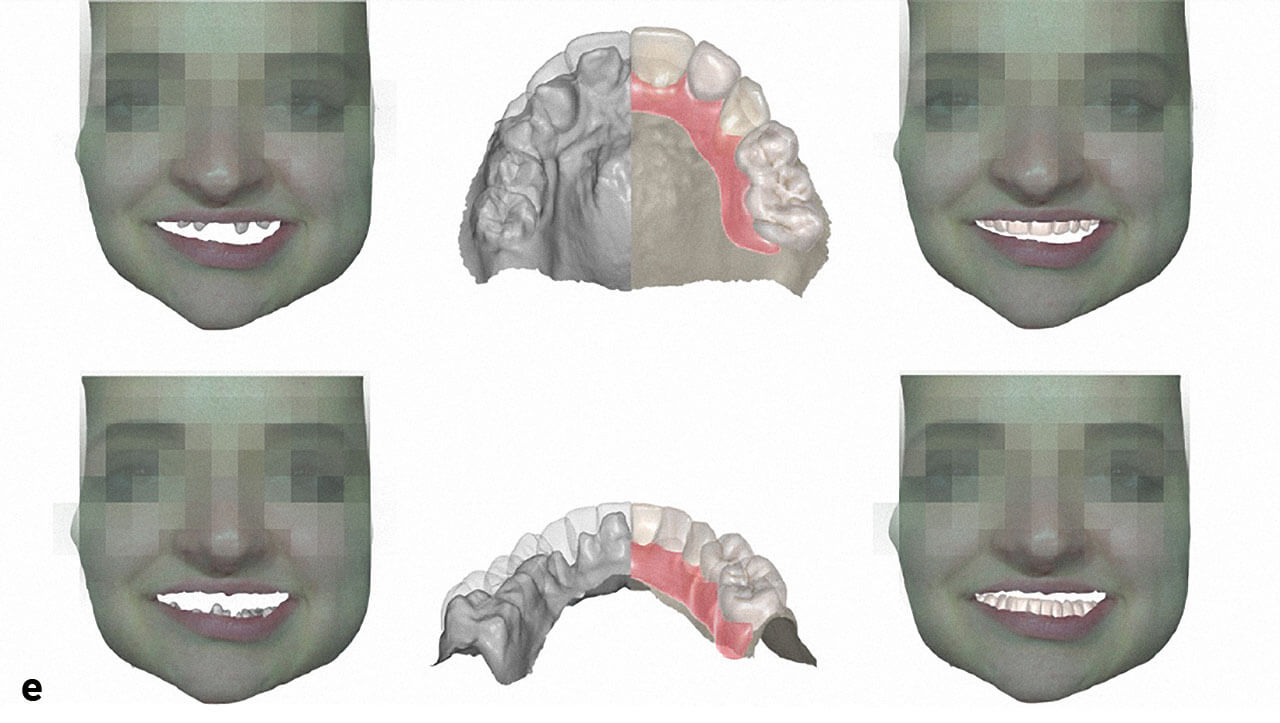 Abb. 3d und e Alternativ ermöglicht der Gesichtsscan die Kontrolle und Festlegung der Kauebene.