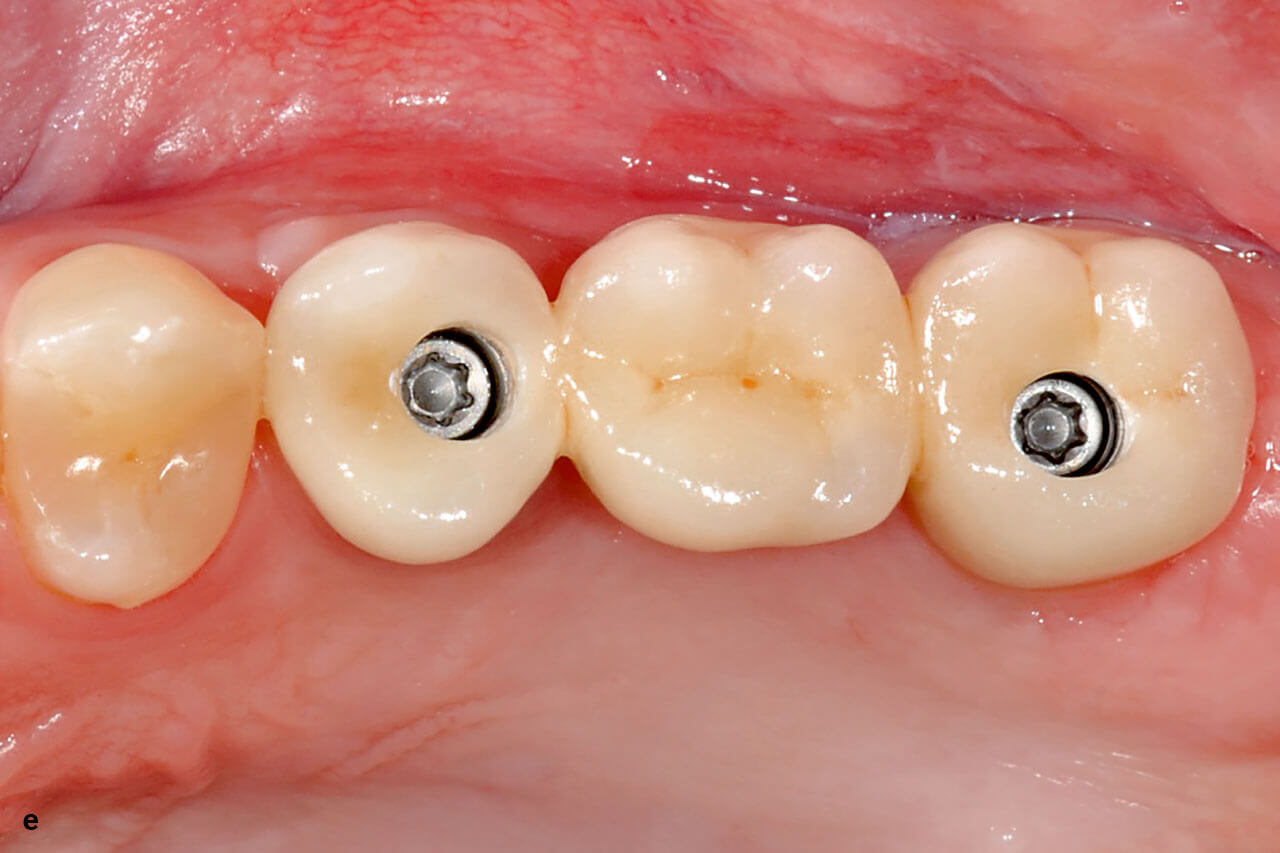 Abb. 1e Digitaler Workflow für die Therapie mit einer dreigliedrigen Implantatbrücke im Seitenzahngebiet: klinische Situation von okklusal mit eingesetzter Implantatbrücke.