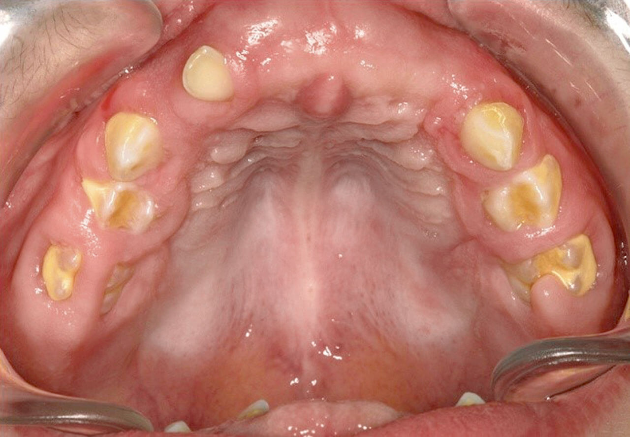 Abb. 4 Medikamenten-induzierte Gingvahyperplasie (MIG) durch Cyclosporin A. Die Patientin litt unter Kauproblemen durch die hyperplastische Gingiva, mangelnde Hygienefähigkeit ist durch deutliche Zahnsteinablagerung erkennbar.