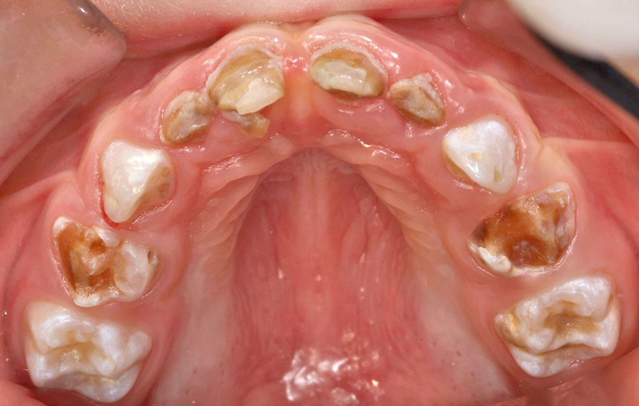 Abb. 8 3-jähriger Patient mit hypoplastischem Linksherzsyndrom (HLHS) und „Early childhood caries“ (ECC). Erstvorstellung: Aufgrund der umfangreichen Läsionen war eine Behandlung in Allgemeinanästhesie nicht vermeidbar.