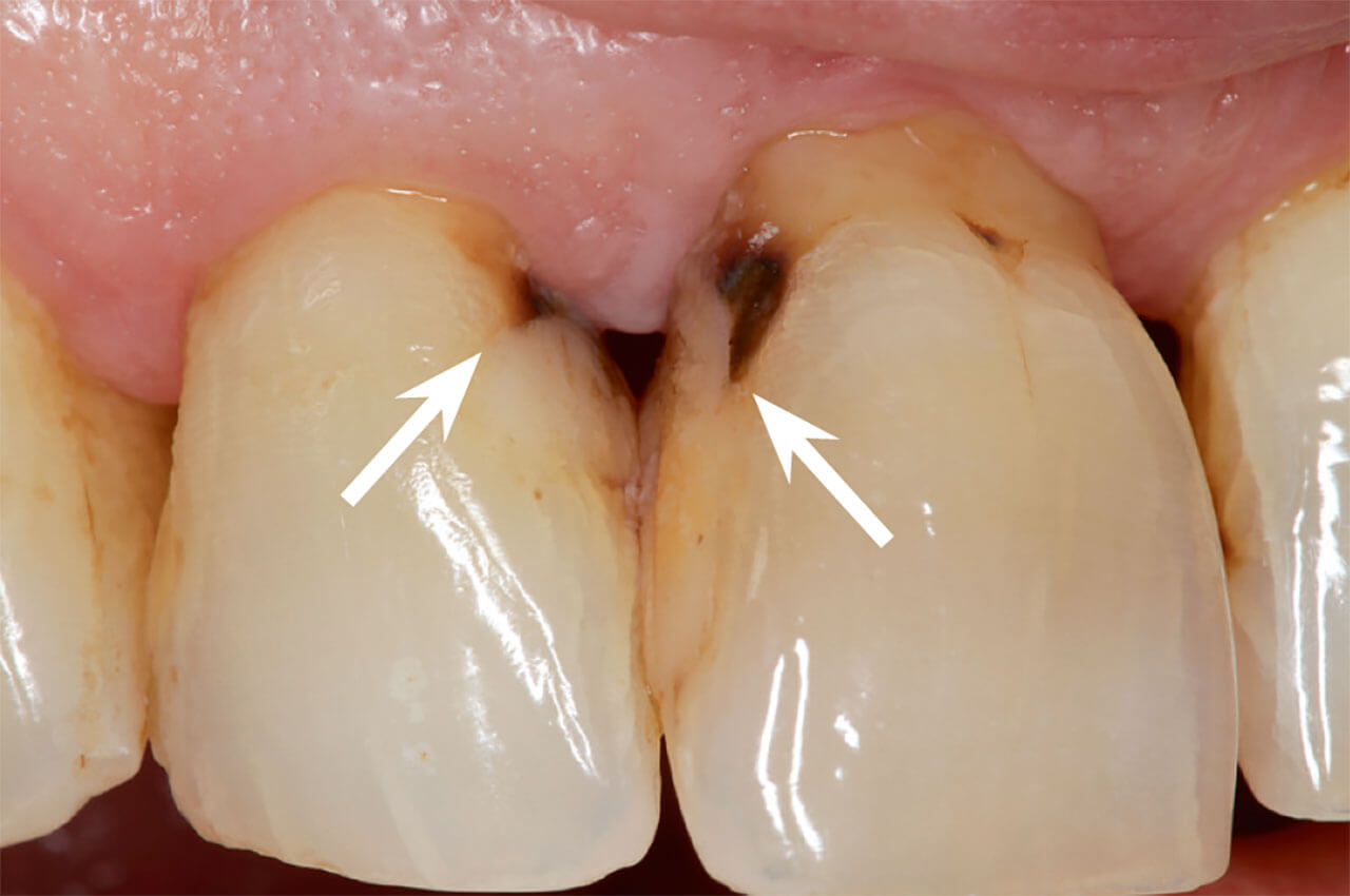 Abb. 2 Beispiel für ein erhöhtes flächenspezifisches Kariesrisiko: dunkel verfärbte, inaktive Wurzelkaries an der Grenze zu Kompositfüllungen (s. weiße Pfeile) nach Rezession im Rahmen einer Parodontitistherapie. Bei intakter Ober­-
fläche sollten derartige, gut zugängliche Läsionen zur Vermeidung einer Progression regelmäßig fluoridiert werden.