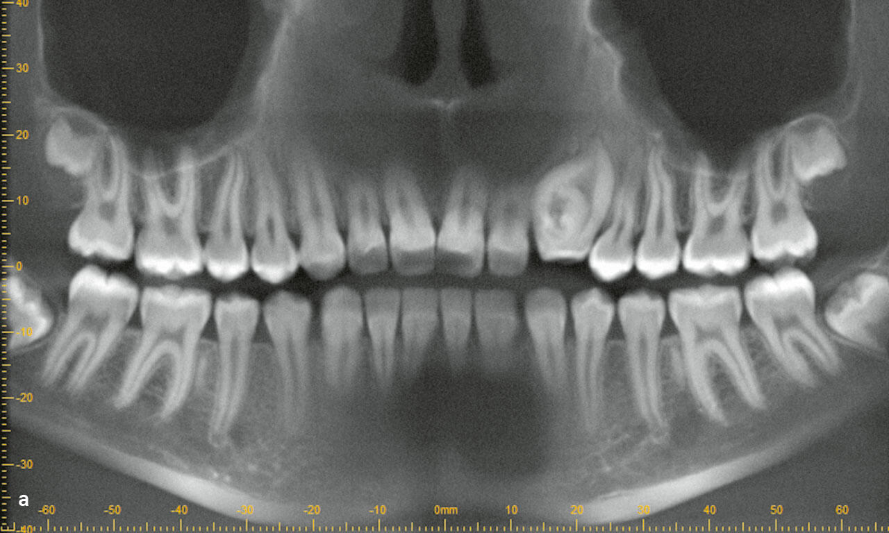 Abb. 3a Orthopantomografie (OPG) mit Dens invaginatus 22.