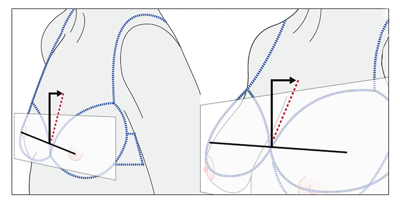 Abb. 3 Der Brustvorsprung bei unterschiedlichen Körbchengrößen (links A, rechts D). 