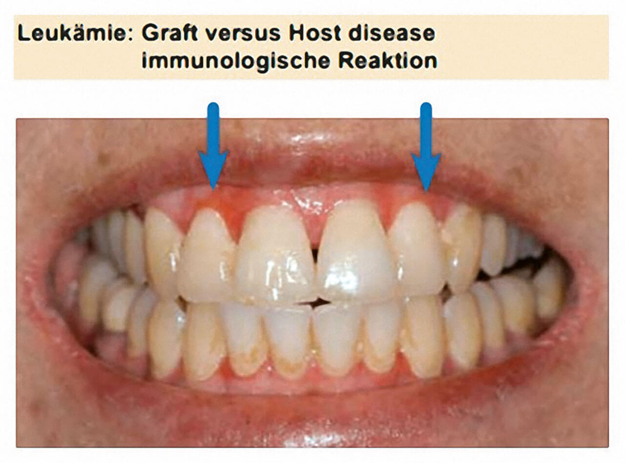 Abb.2 Systematische klinische Einordnung am Beispiel „Graft-versus-host disease“ (GvHD). 