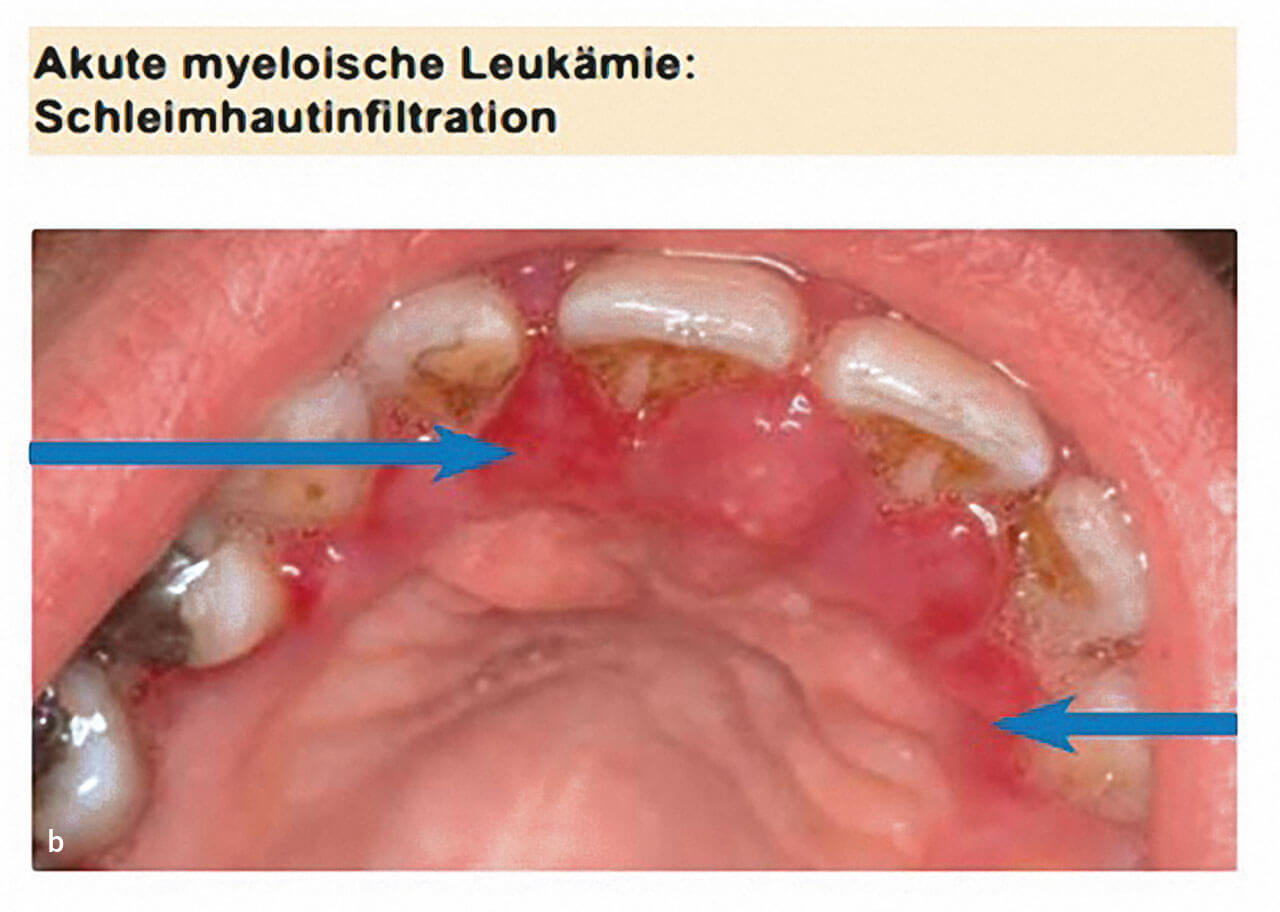 Abb. 3a und b Systematische klinische Einordnung am Beispiel der myeloblas­tären Anämie (oben) und der myeloischen Leukämie (unten).
