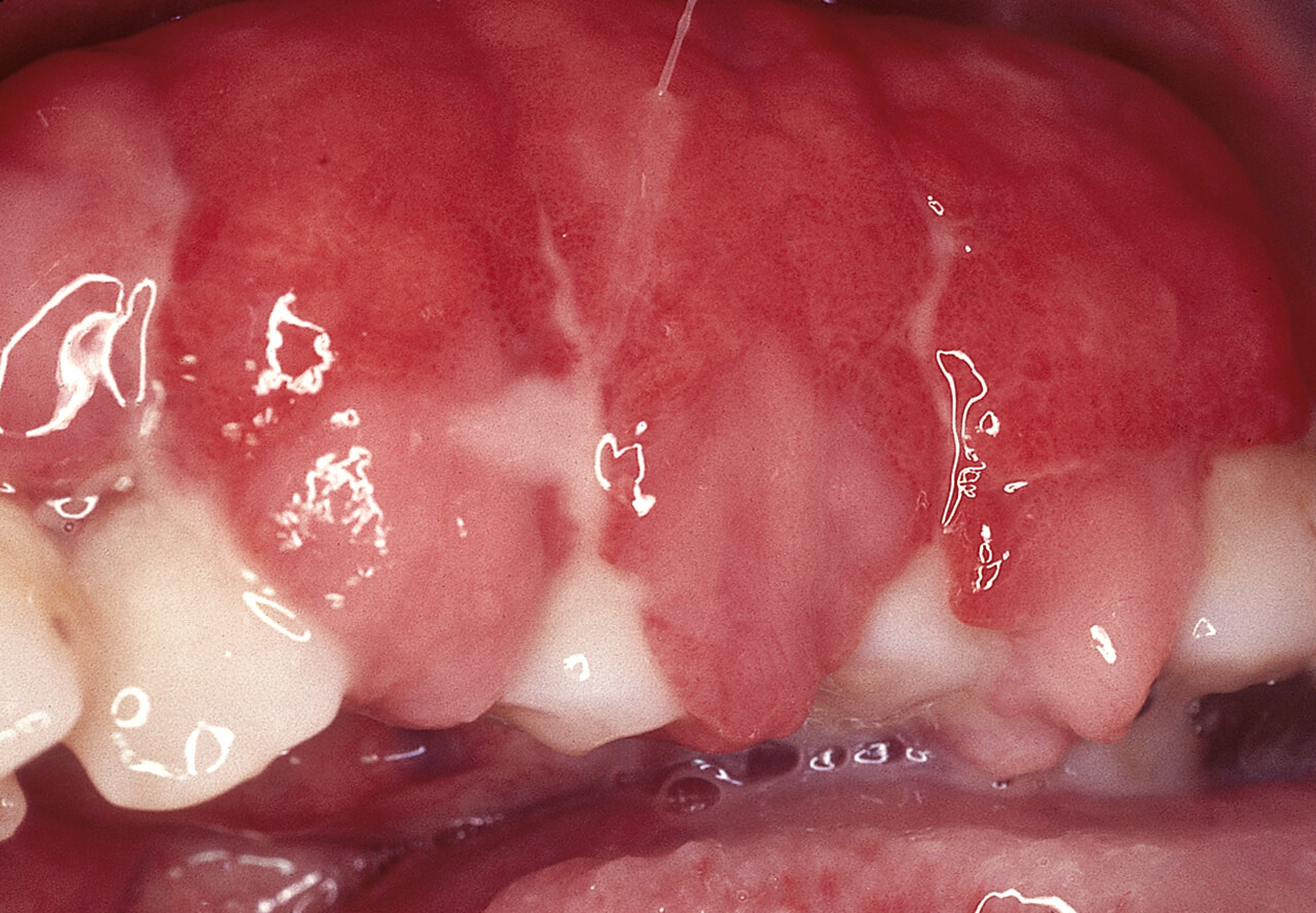 Abb. 1 Ausgeprägte Gingivahyperplasie des Oberkiefers bei Phenytoineinnahme (aus: Ebhardt H, Reichart PA, Schmidt-Westhausen AM. Curriculum Spezielle Pathologie für Zahnmediziner. Berlin: Quintessenz, 2018).