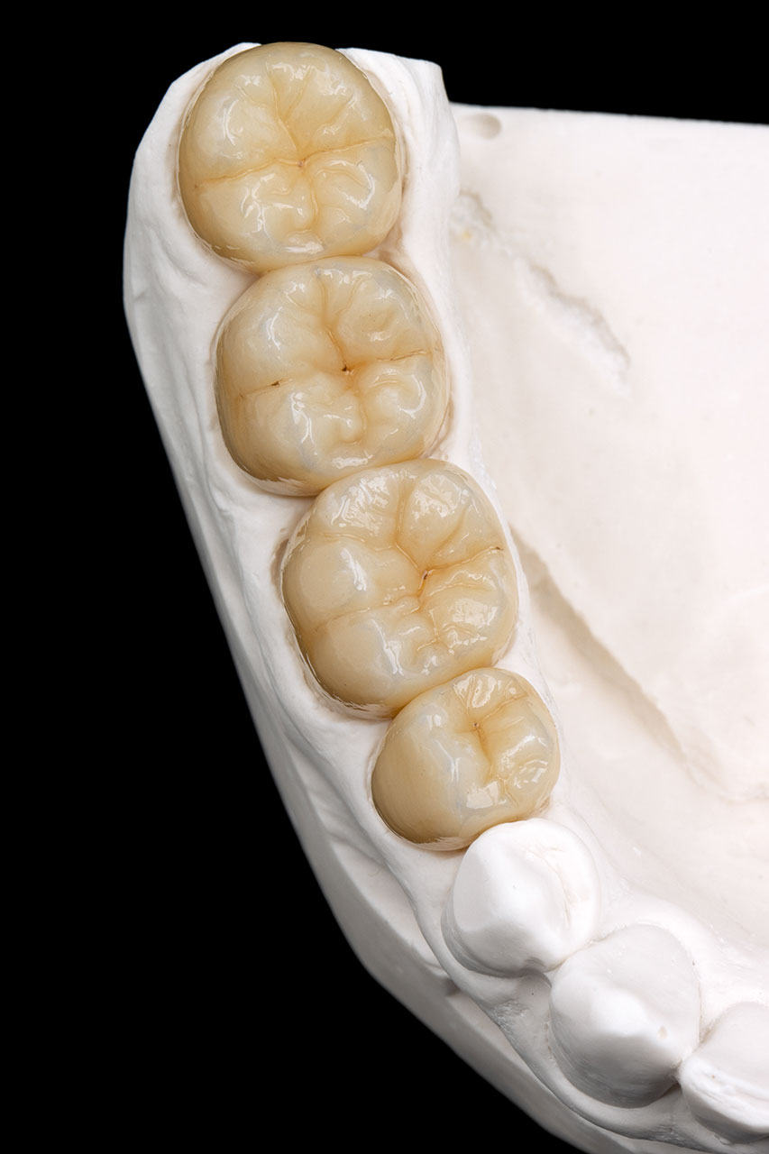 Abb. 18 Zahnersatz aus einer Kombination aus zahnfarbtragenden Zirkonoxid, einer exakt geplanten Morphologie sowie einer hauchdünnen Schicht Verblendkeramik.