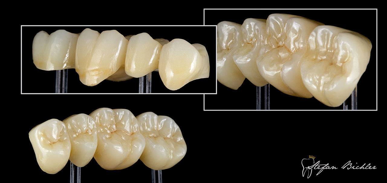 Abb. 4 Vollkeramische Brücke, umgesetzt im Mikrolayering (2-D- und 3-D-Pastenkeramik ceraMotion One Touch, Dentaurum, Ispringen).