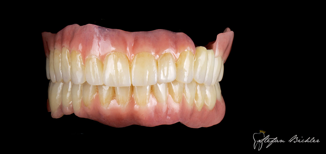 Abb. 5 Flexibel in der Anwendung: All-in-on-Restauration von Stefan Bichler. Die Zähne aus PMMA wurden in ceraMotion® CADback (Fa. Dentaurum, Ispringen) reduziert und dann individuell geschichtet.