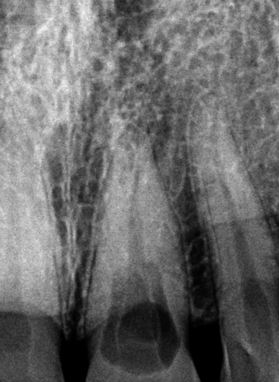 Die Entscheidungsfindung hinsichtlich der therapeutischen Vorgehensweise setzt eine genaue Analyse des Resorptionsdefektes voraus. Mit dem Ziel, sich ein genaues Bild über Größe, Lage und Ausdehnung der Wurzelresorption zu machen, stehen hierbei neben der Beurteilung der klinischen Situation vor allem auch die genaue Auswertung der Röntgenbilder einschließlich computertomographischer Aufnahmen im Mittelpunkt.