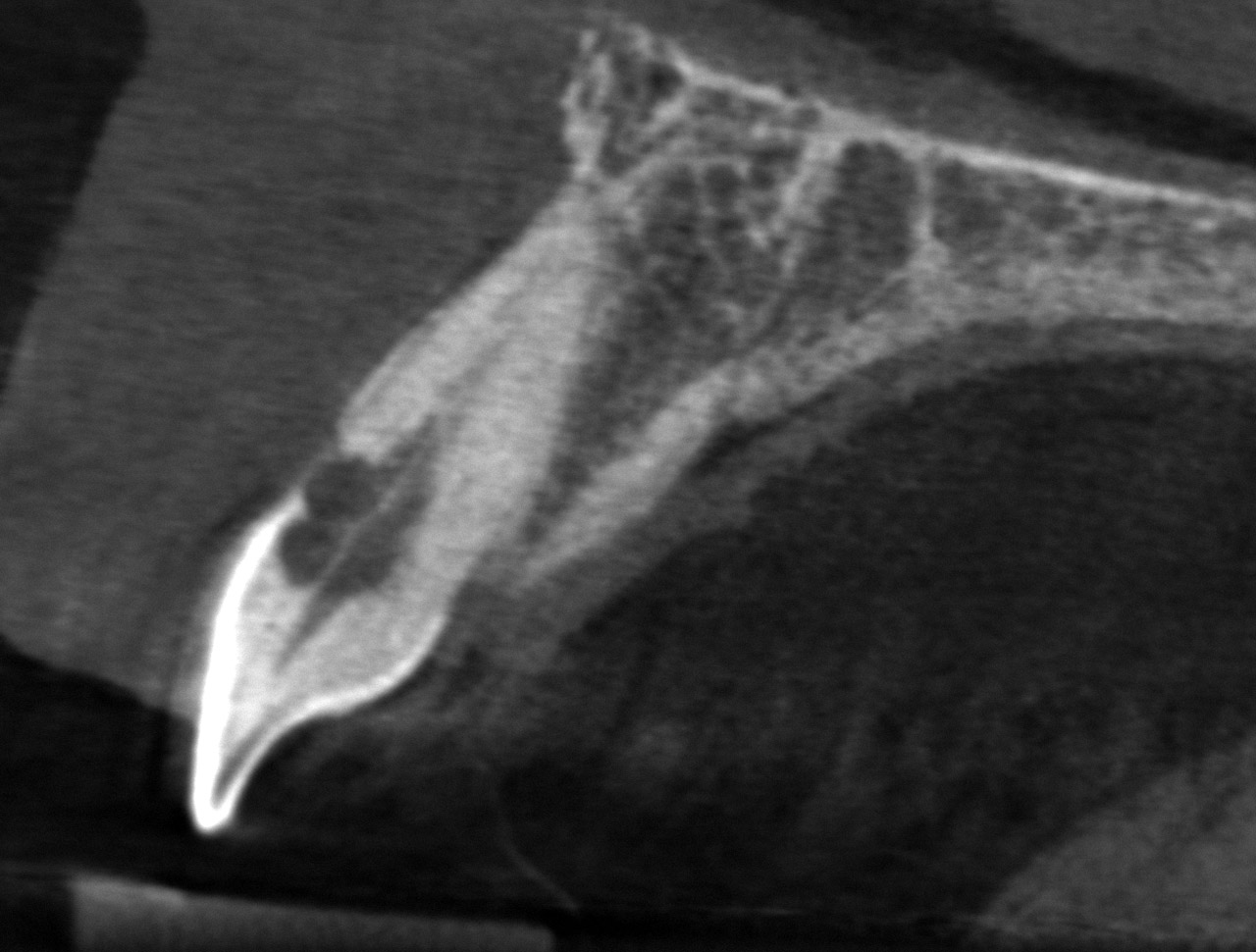 Da der Zahn vital und auf den Röntgenbildern eine feine Abgrenzung zwischen Wurzelkanal und Resorptionslakune zu erkennen ist, ergibt sich in diesem Fallbeispiel die Diagnose einer hyperplastisch-invasiven zervikalen externen Resorption, welche nicht mit dem Pulpenkavum kommuniziert sowie auf das koronale Wurzeldrittel und weniger als die Hälfte des Wurzelquerschnittes beschränkt ist.