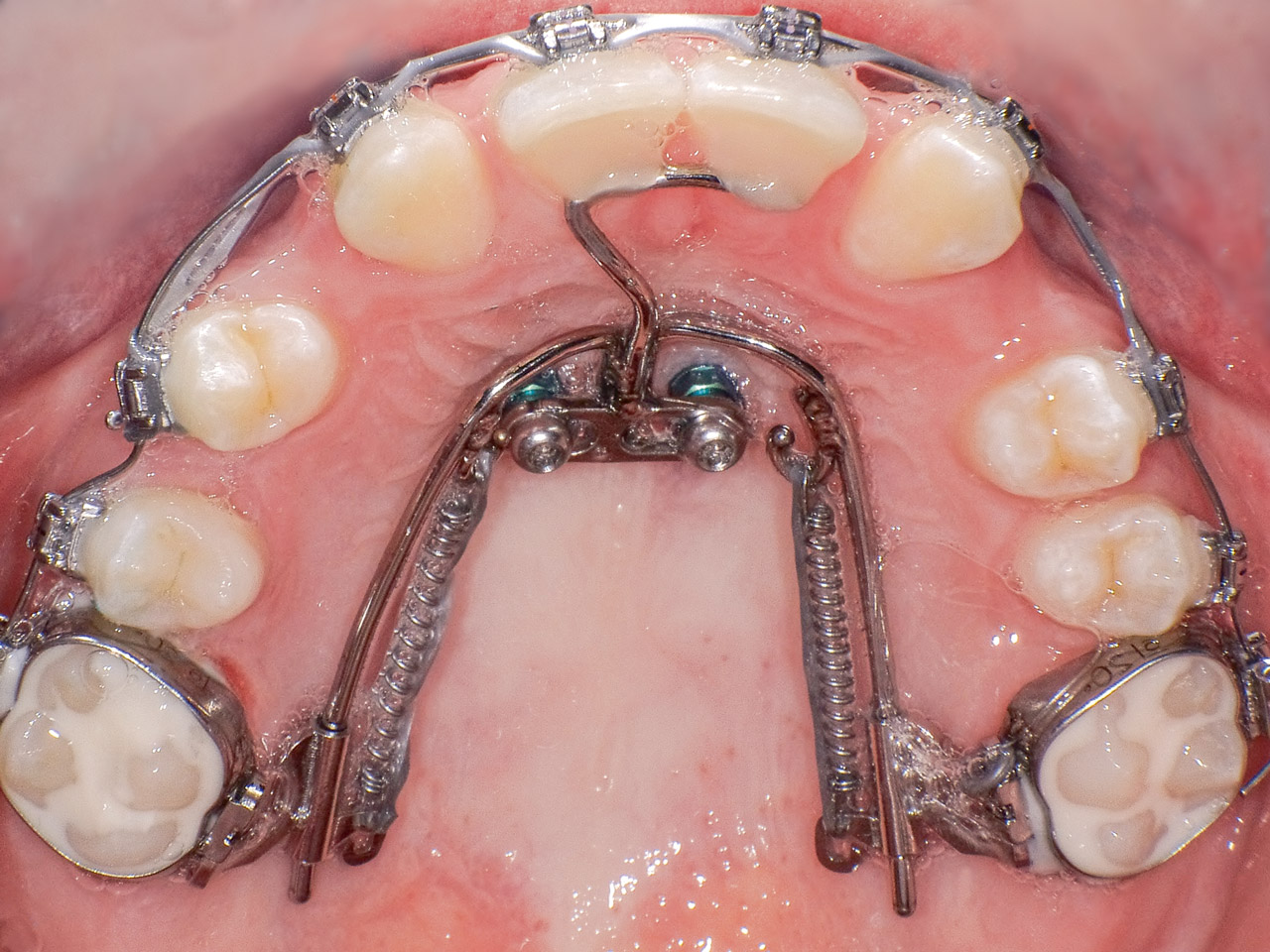 Situation nach Inserieren palatinaler Miniimplantate und Eingliedern der kieferorthopädischen Apparaturen. Im Oberkiefer kommt ein „T-Mesialslider“ zur Mesialisierung der Eck- und Seitenzähne zum Einsatz.