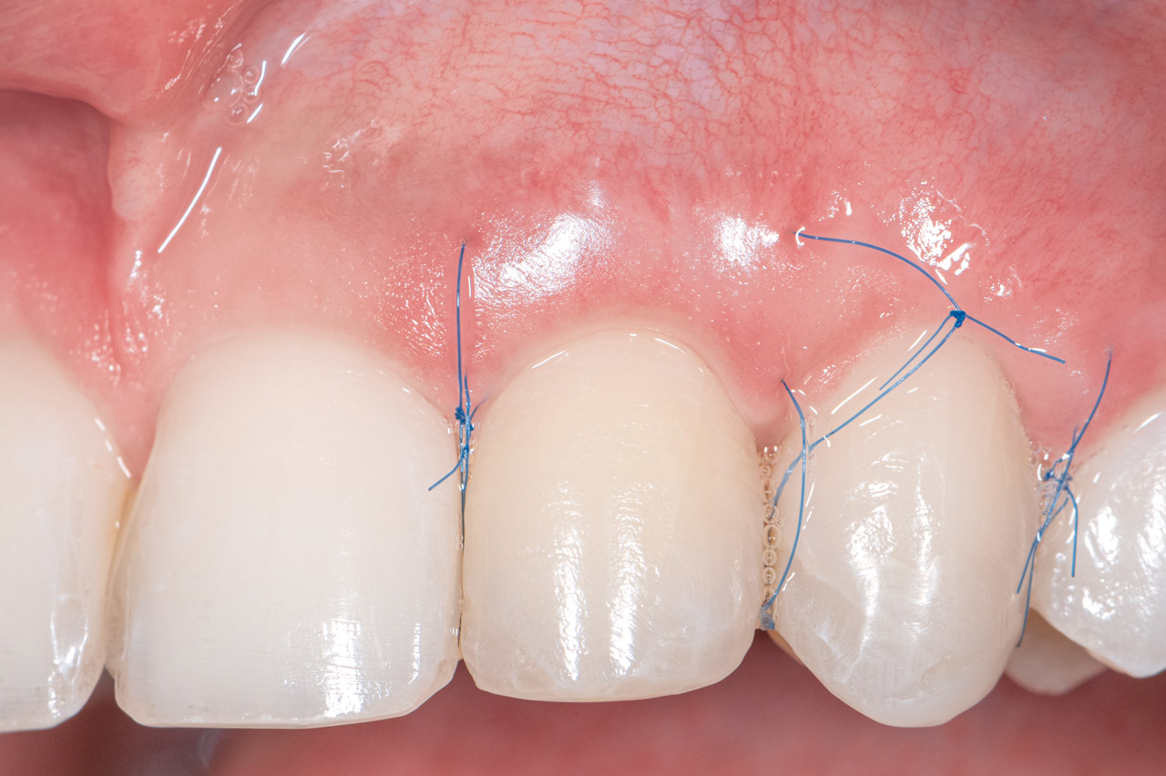 Klinische Situation eine Woche nach gingivaler Rezessionsdeckung unter Anwendung der kombinierten Tunneltechnik, vor der Entfernung der Nähte.