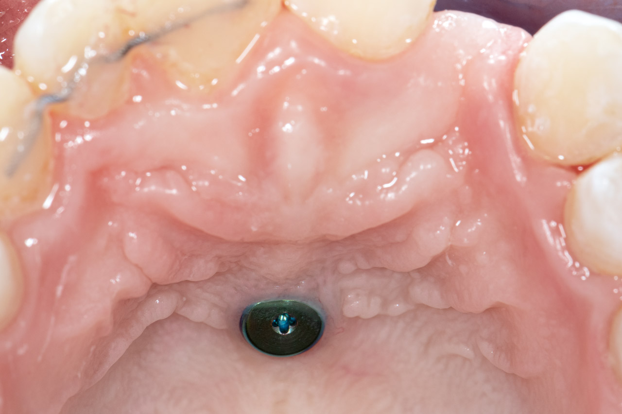 Sechs Wochen vor dem Eingriff wurde ein Gaumenimplantat eingebracht und zur Anfertigung eines Langzeitprovisoriums digital abgeformt.