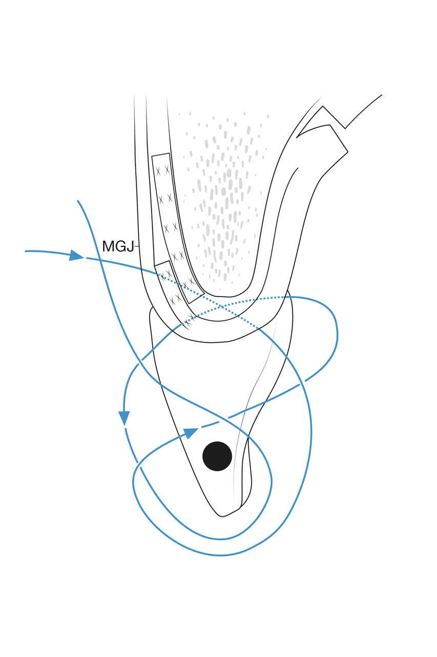 Schematische Darstellung des fertiggestellten Nahtverschlusses ﻿(MGJ = mukogingivale Grenzlinie)