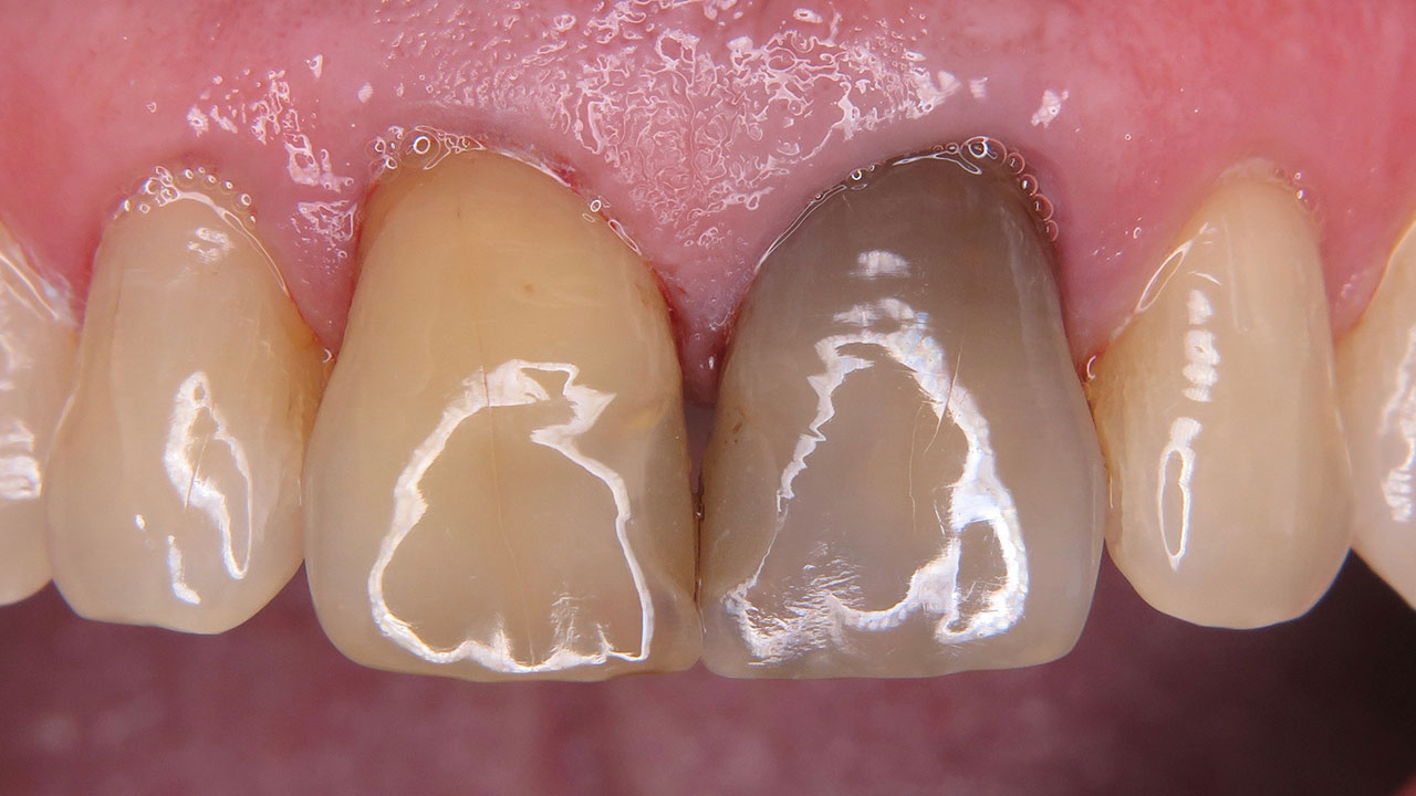 Zahn Gerettet Aber Grau Bleichen Aus Endodontischer Perspektive Quintessenz Verlags Gmbh