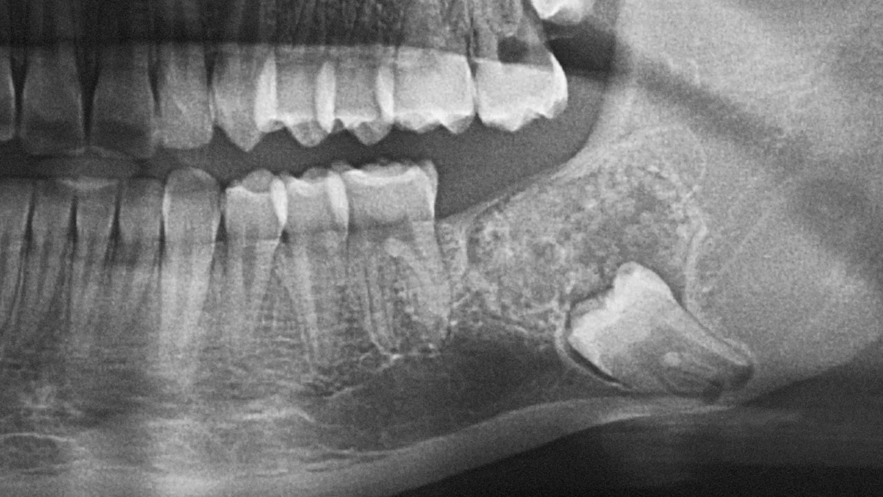 Interdisziplinare Behandlung Eines Komplexen Odontoms Quintessenza Edizioni S R L