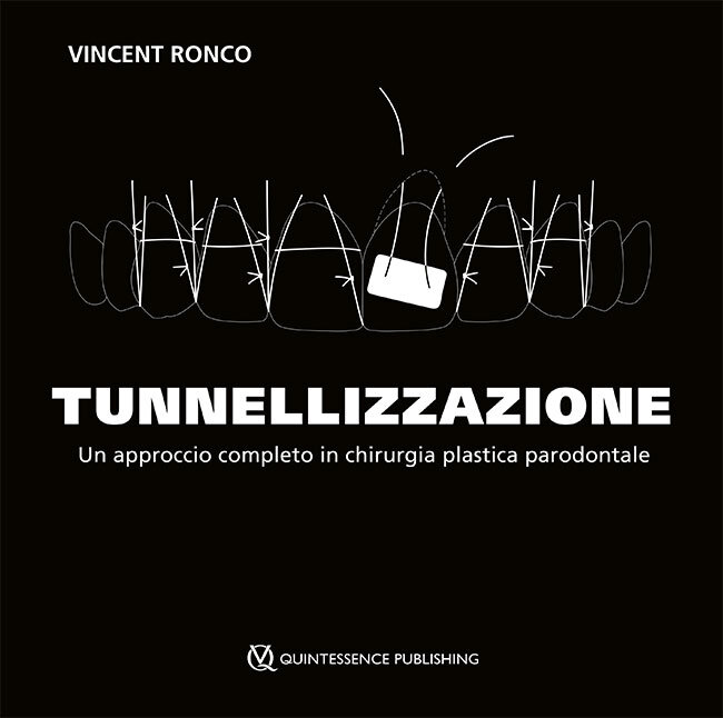 Ronco: Tunnellizzazione