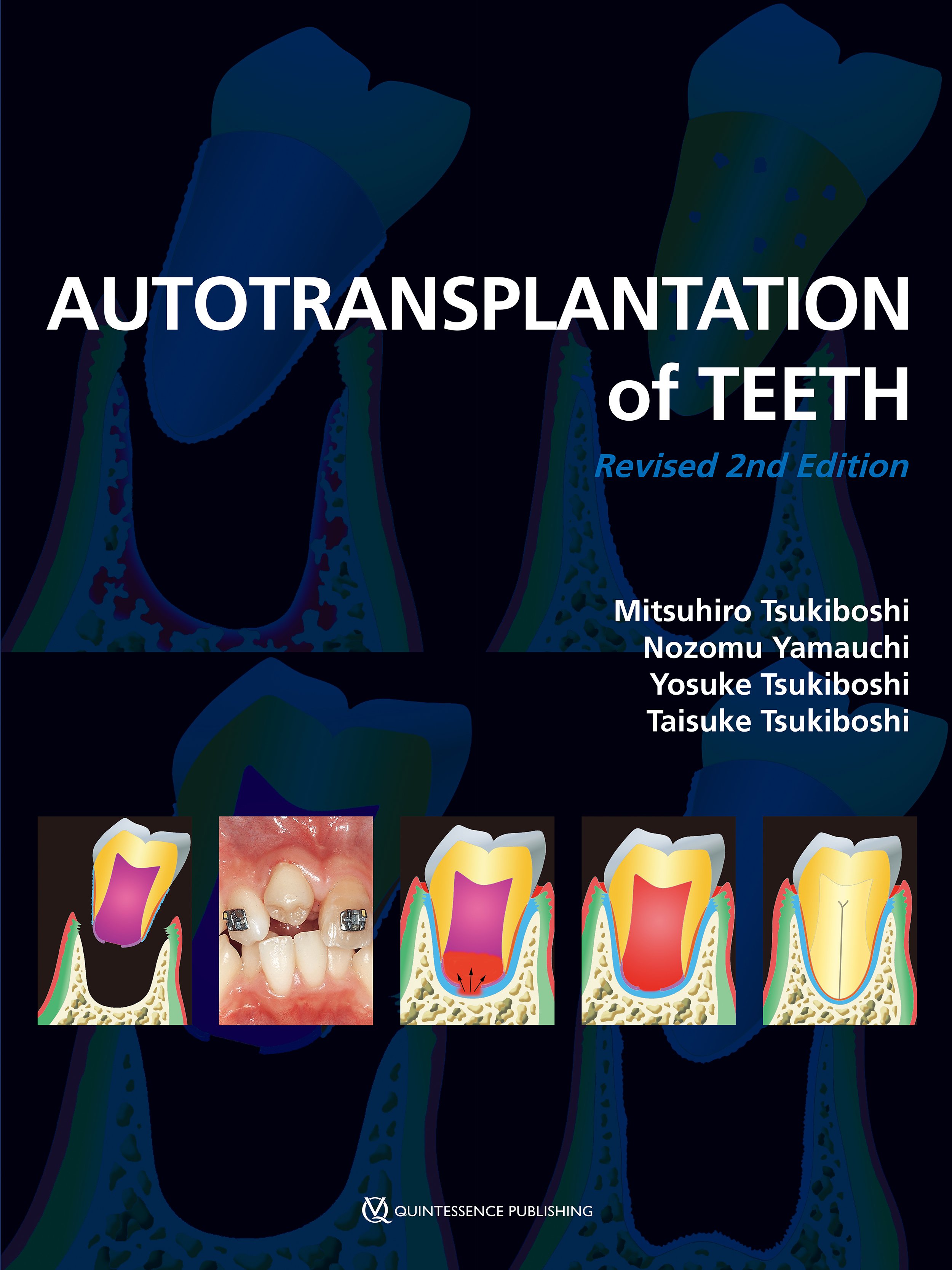 Tsukiboshi: Autotransplantation of Teeth