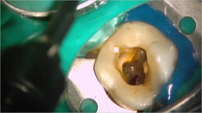 Covering a perforation during endodontic treatment of tooth 16 using ...